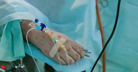 WHO podało, ile osób zaraziło się małpią ospą. Liczba przekracza 41 tys.