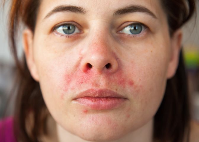 Gronkowiec w nosie zwykle wywołuje objawy u osób z osłabioną odpornością organizmu.