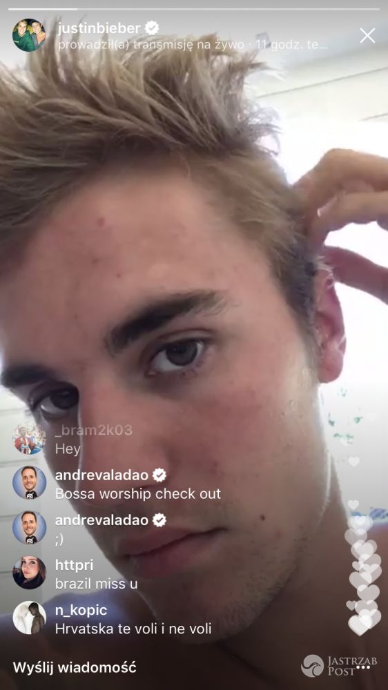 Justin Biber ma poważne problemy ze skórą