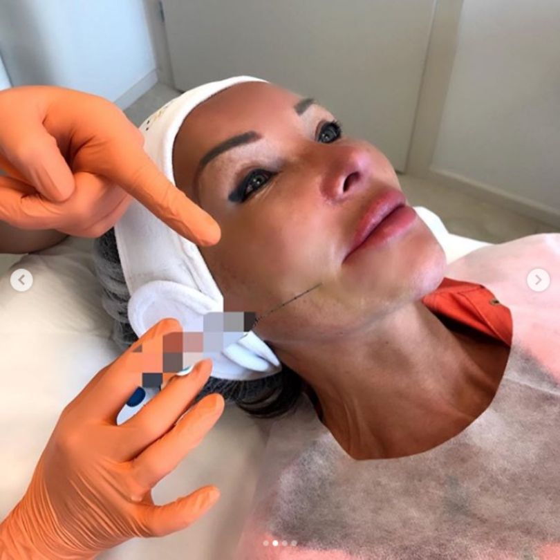 Ewa Minge pochwaliła się zabiegiem medycyny estetycznej