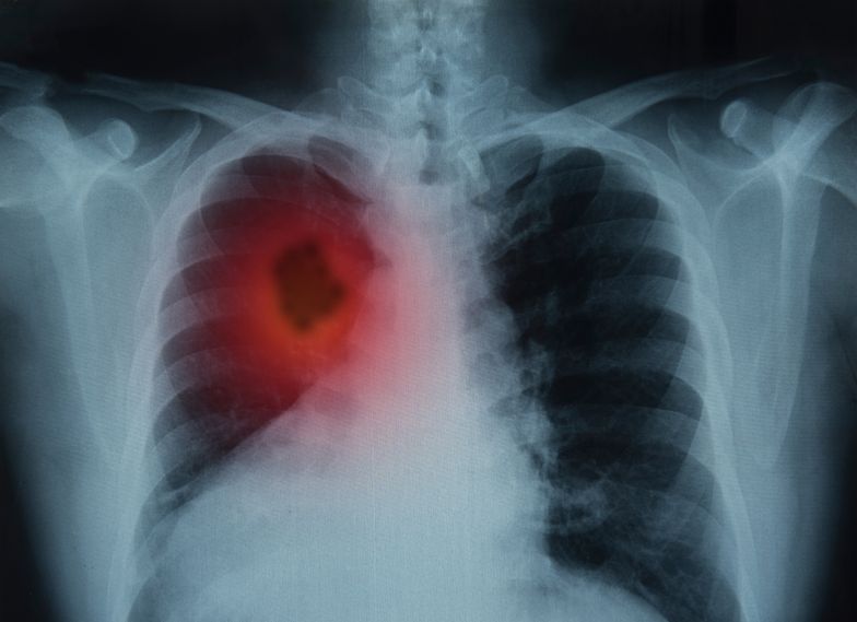 Rak płuc może dawać nietypowe objawy