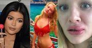 24-latka chciała mieć usta jak Kylie Jenner. Skończyło się tak!