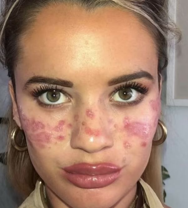 Tilly pokazała, jak wygląda jej twarz po nieudanym zabiegu