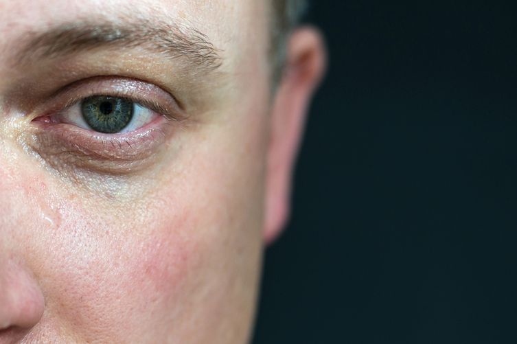 Cienie pod oczami to jeden z sygnałów chorej wątroby