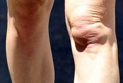 Kirsten Dunst: Mało apetyczne kolana 31-letniej gwiazdy