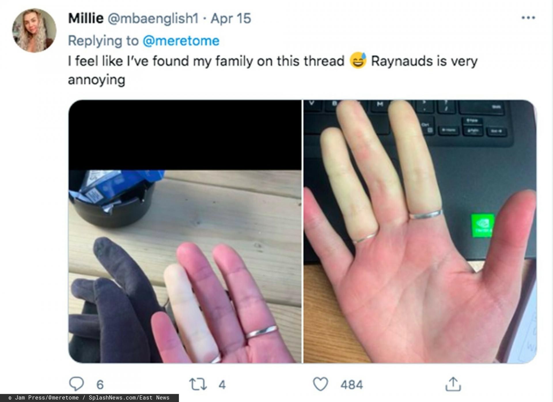 Objaw Raynauda charakteryzujące się nagłym blednięciem, a następnie zasinieniem palców rąk, stóp, czasami nosa oraz uszu