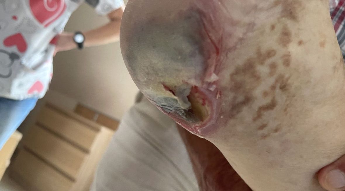 Rozległa rana na łokciu Mariana Hausmana w dniu wypisu ze szpitala