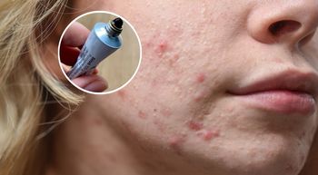 Wyciąga pryszcze niczym "odkurzacz". W aptece kupisz za grosze