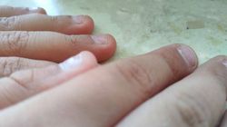 Linie Beau na paznokciach. Mogą świadczyć o przejściu choroby Kawasakiego lub zapalenia płuc