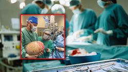 Usunęli guz jajnika ważący 20 kg. Takie dawał objawy