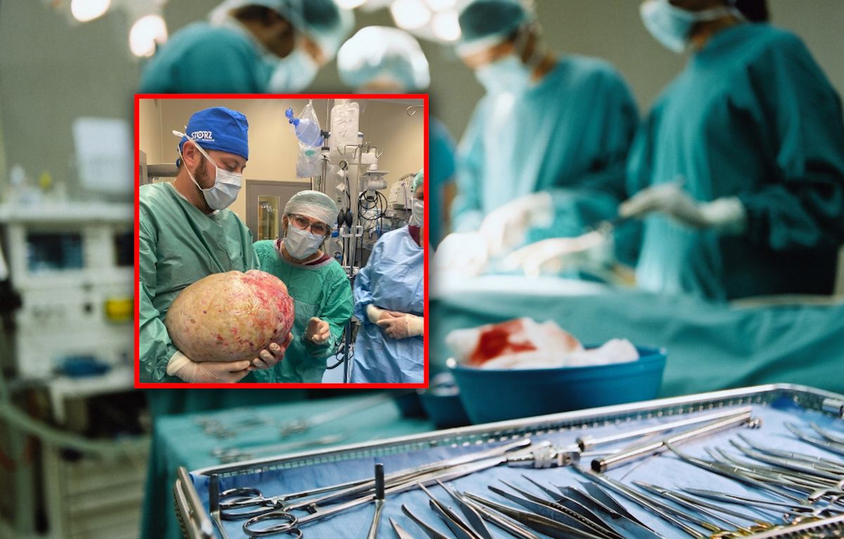 Usunęli guz jajnika ważący 20 kg. Takie dawał objawy