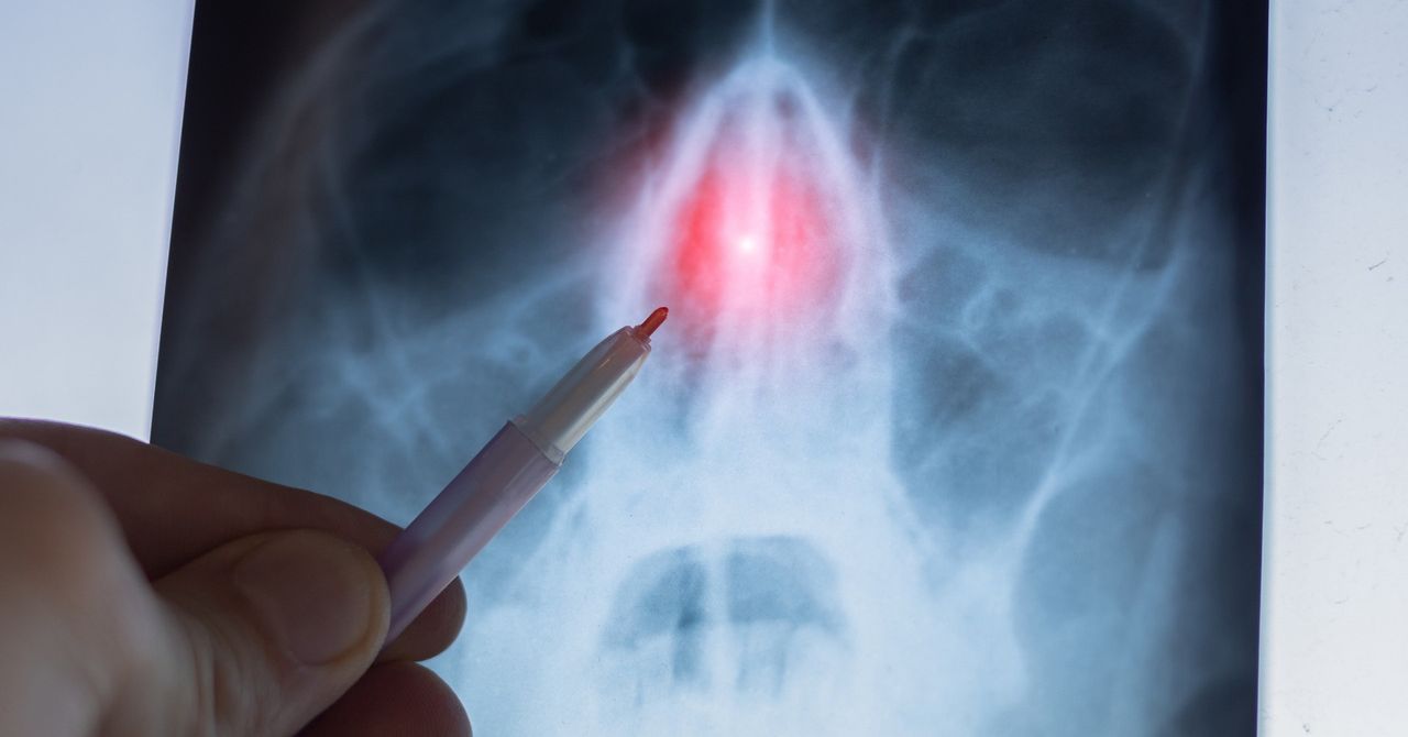 Czy warto wyprostować krzywą przegrodę w nosie? Czy to boli? Czy potem czuć różnicę? Opowiem ci, jak było u mnie