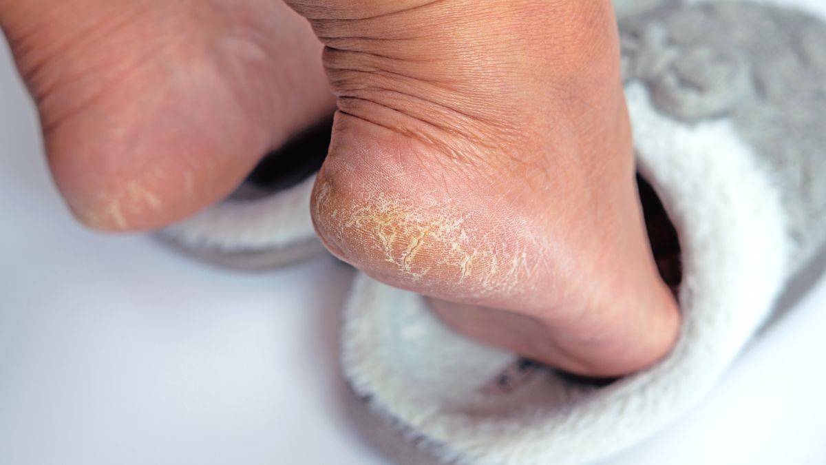 Jak zregenerować suche pięty?