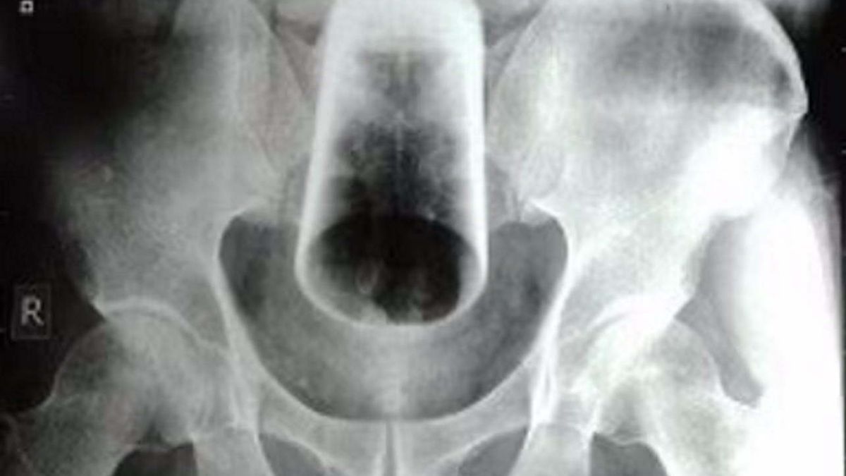 Mężczyzna trafił do szpitala z ciałem obcym w odbycie