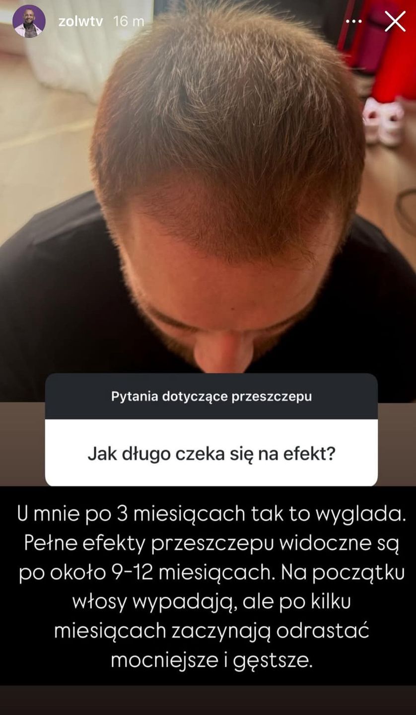 Chłopak Ewel0ny chwali się efektem przeszczepu włosów