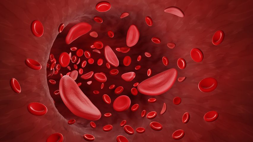 Niedokrwistość sierpowata charakteryzuje się nieprawidłową budową hemoglobiny