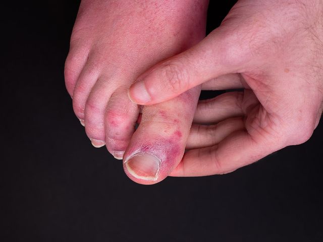 Po przejściu COVID mogą się pojawić plamy i zaczerwienienia na stopach. Część pacjentów narzeka na swędzenie i łuszczenie skóry