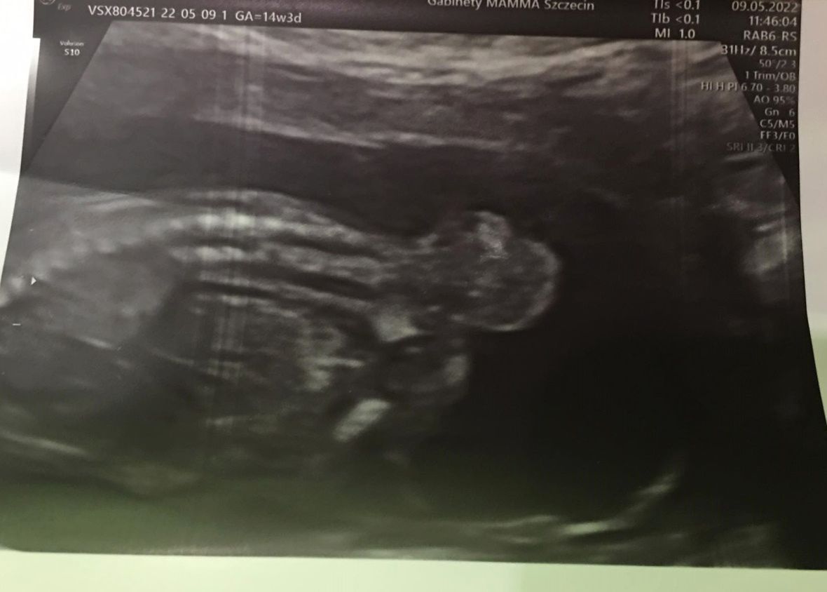 U córeczki 18-latki zdiagnozowano potworniaka okolicy krzyżowej kręgosłupa
