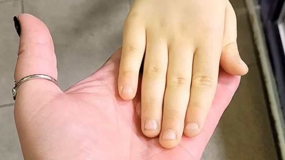 Skóra malucha miała żółty odcień