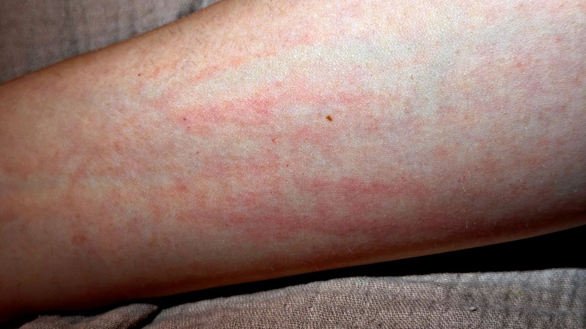 Świerzb jest schorzeniem dermatologicznym, a nie dowodem braku higieny.