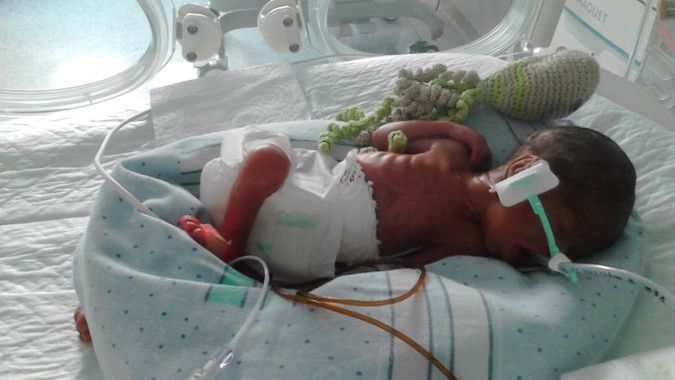 Kubuś urodził się w 26 tygodniu ciąży.