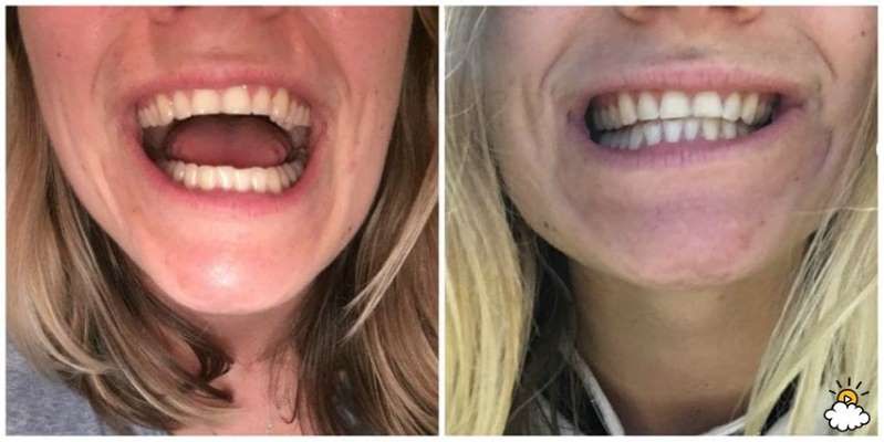 Węgiel aktywny delikatnie wybielił zęby