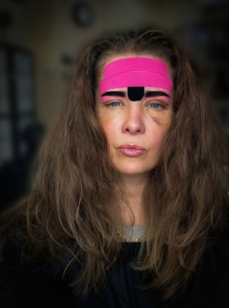 Anna Powierza pokazała się podczas gojenia ran po zabiegach medycyny estetycznej