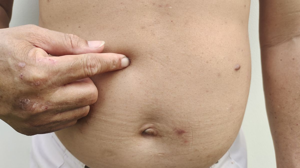 The obesity, overweight and fatty on the belly.
Portrait showing the flabbiness adipose hanging skin, obesity and flabby skin, overweight and fatty on the belly of the male patient, health care and medical concept.
Rungrudee