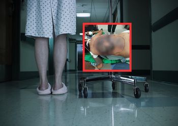 Nie leczyła cukrzycy. Lekarze pokazali, jak wyglądają jej plecy