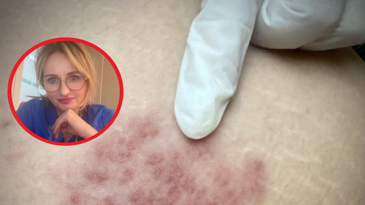 Chore płuca widać na twarzy