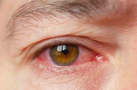 Koronawirus powoduje przekrwienie oczu? Objawem Covid-19 może być zapalenie spojówek