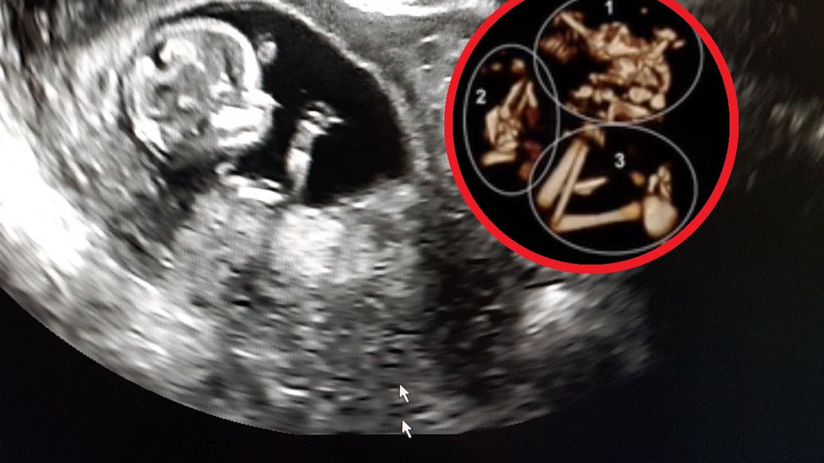 Lekarz wyjaśnia czym jest "syndrom znikającego bliźniaka". Wiele kobiet nie wie, że było w ciąży bliźniaczej