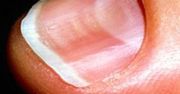 Co twoje paznokcie mówią o twoim zdrowiu?