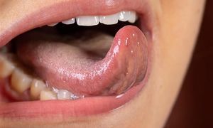 Masz biały nalot na języku? Endokrynolożka ostrzega