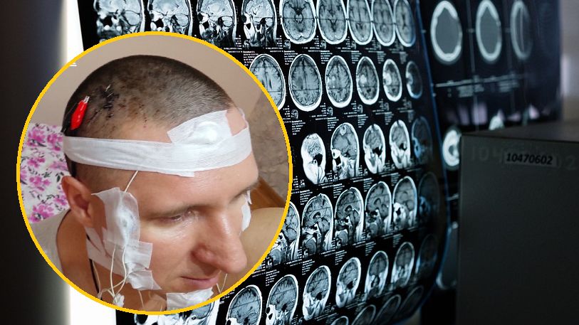 Rosjanin sam zrobił sobie operację głowy, cudem ją przeżył