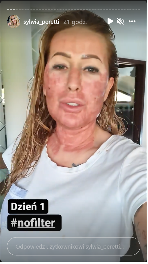 Sylwia Peretti po zabiegu laserowym