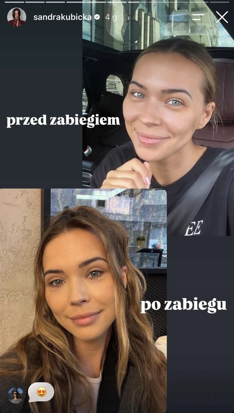 Sandra Kubicka przed i po operacji