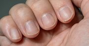 Masz takie plamki na paznokciach? Specjalista ostrzega