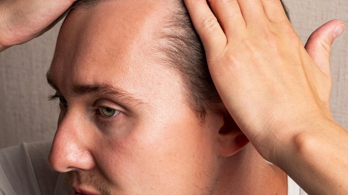 Wypadanie włosów spotyka coraz młodszych mężczyzn - jak spowolnić ten proces?