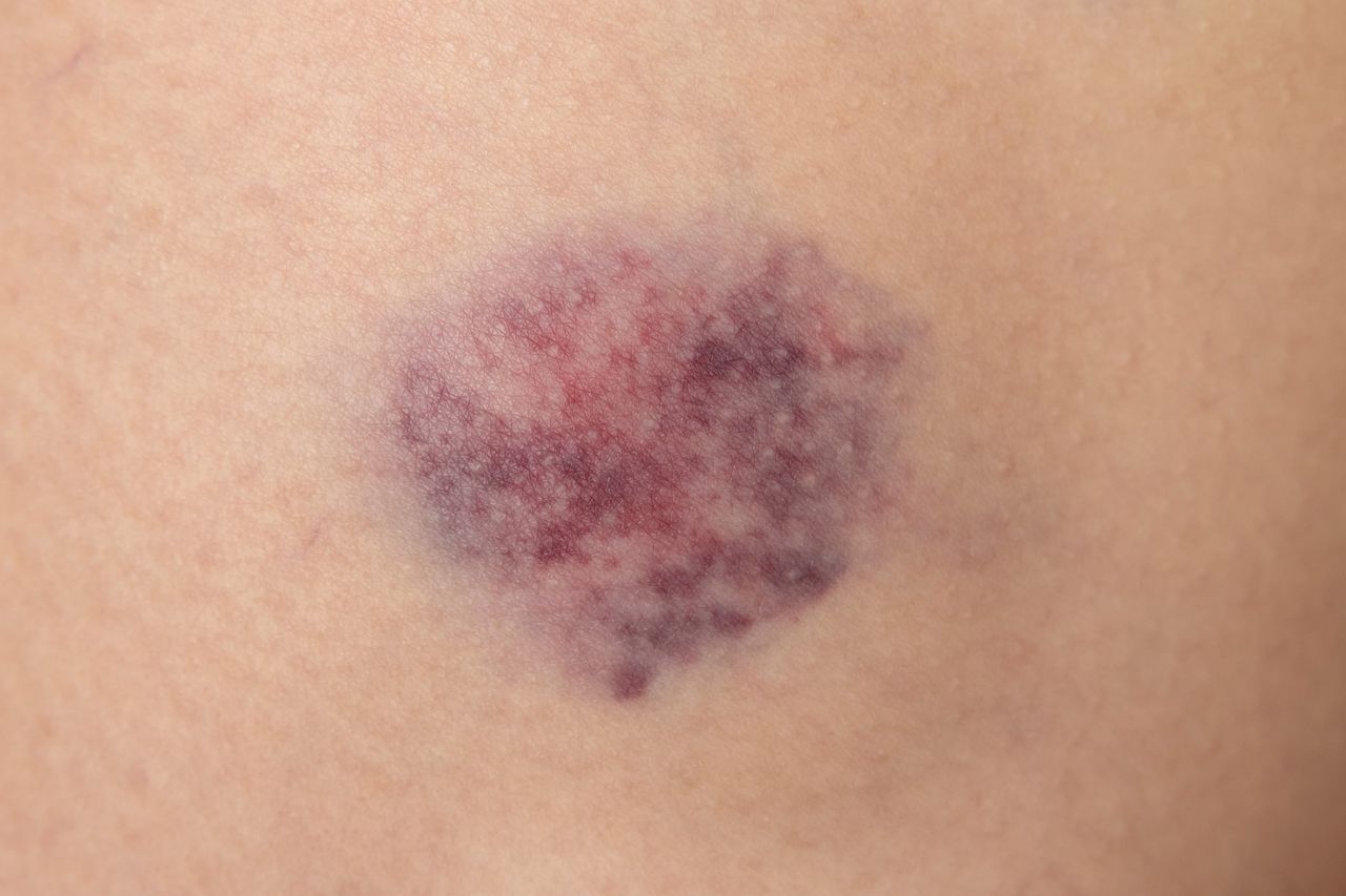 Doctor warns: Unexplained bruises could signal serious conditions