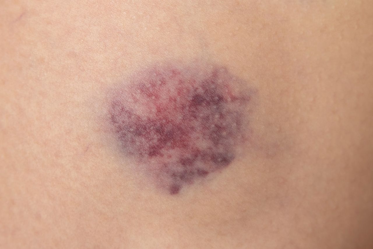 When should we be concerned about bruises? / illustrative image