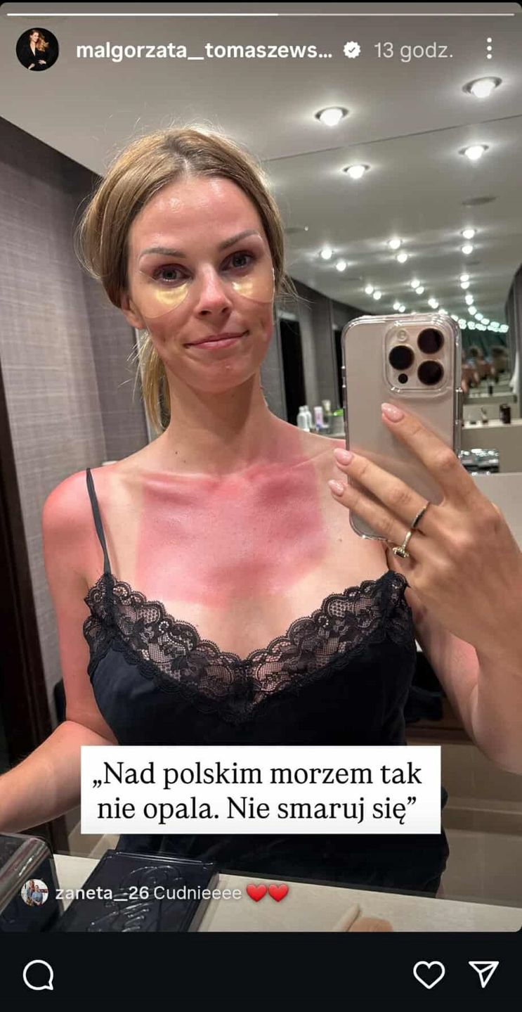 Małgorzata Tomaszewska spalona słońcem