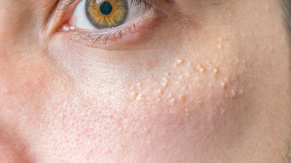 Białe kropki pod oczami to najczęściej kaszaki lub prosaki. Ich pojawienie się nie świadczy o chorobie.