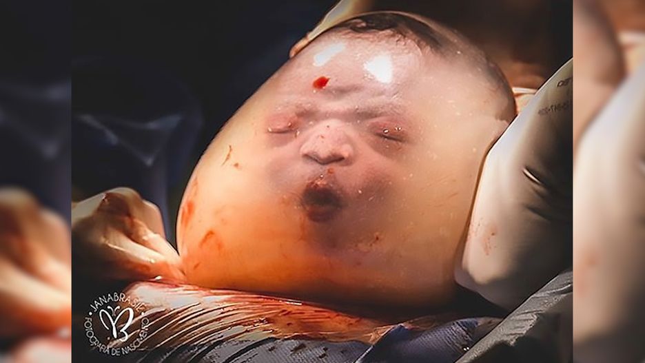 Nietypowy poród. Zdarza się raz na sto tysięcy