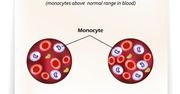Monocytoza – przyczyny, diagnostyka i leczenie