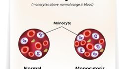 Monocytoza - przyczyny, diagnostyka i leczenie