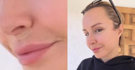 Blanka Lipińska relacjonuje lifting ust po usunięciu kwasu: "Jakość skóry pod nosem teraz jest dużo lepsza"