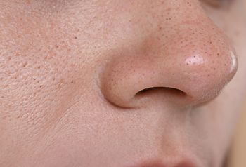 Pożegnaj wągry raz na zawsze. Ta maseczka działa cuda