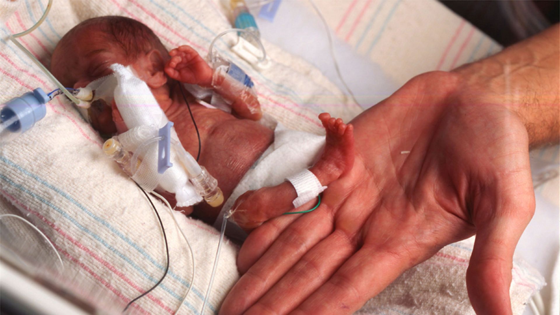 Wcześniak o wadze 267,46 g / Fot. Loyola Univ. Medical Center 