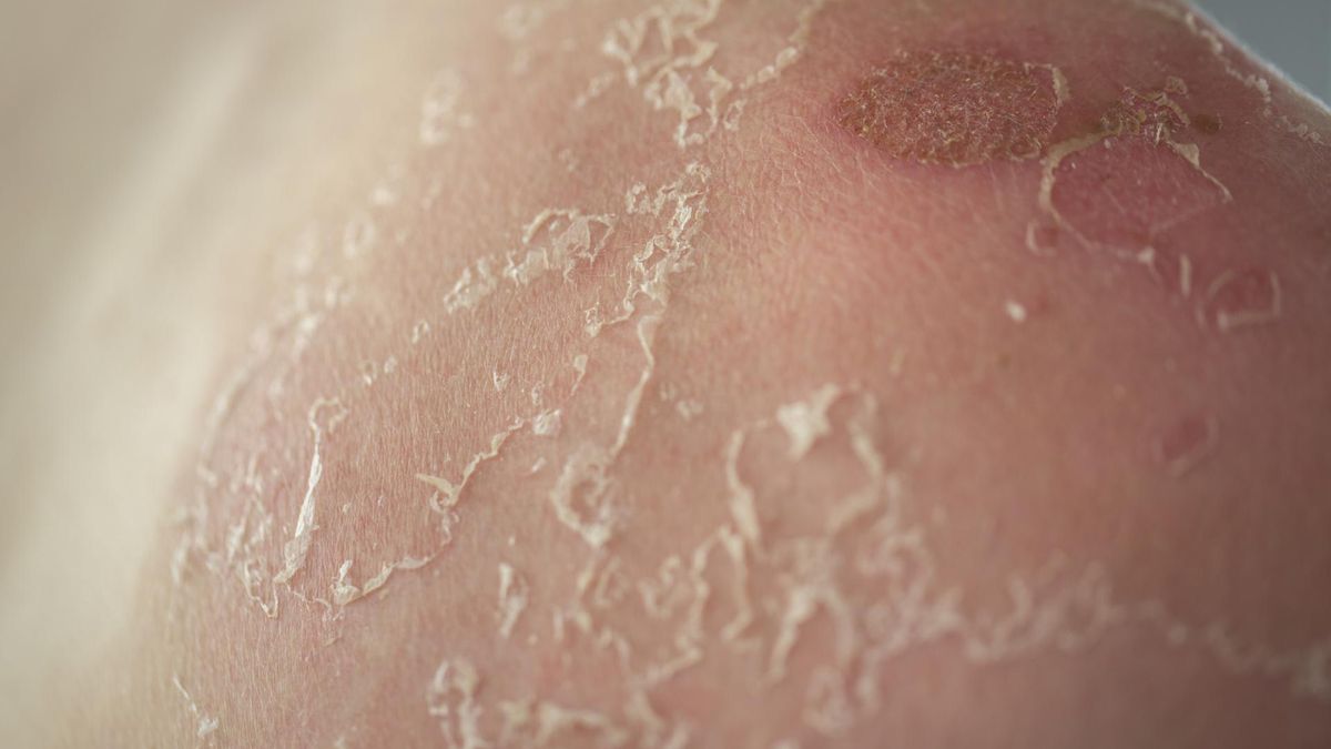 Skóra po poparzeniu słonecznym wymaga szczególnej ochrony. Unikaj ekspozycji na słońce i zadbaj o odpowiedniej nawilżenie